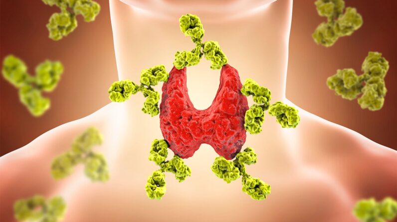 Hashimoto’s Sufferers Felt Greater for five A long time Immediately after Thyroidectomy